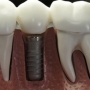 Experience Safe & Advanced Dental Implants in Norcross, Georgia.